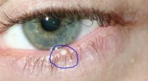 A bump on the lower eyelid, which could lead to an ingrown eyelash image picture photo