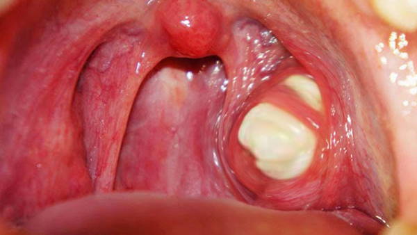 A close up view of the tonsil stones Holes in tonsils image photo picture