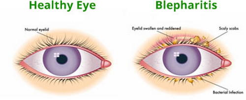 A comparison image between a healthy eye and an eye with blepharitis ingrown eyelash image photo picture