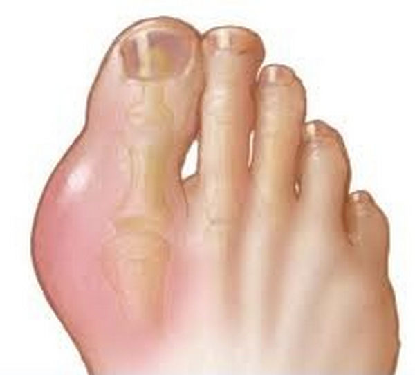 A sprained big toe with swelling and inflammation image photo picture