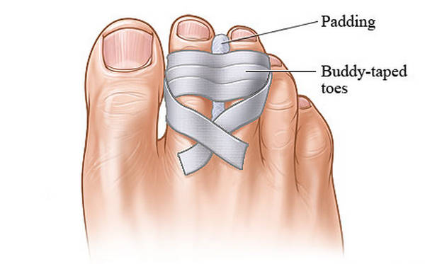 A sprained toe taped to the adjacent toe image photo picture