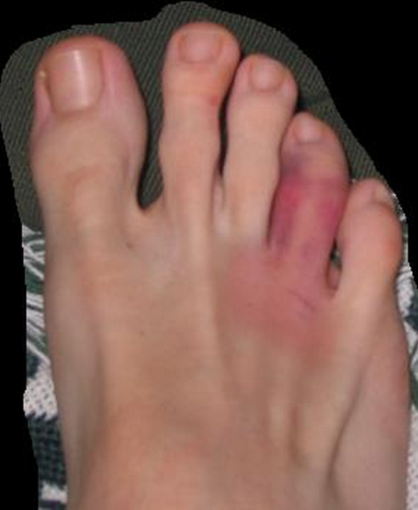 A sprained toe with a reddish to bluish discoloration of the skin