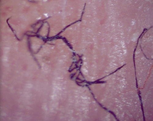 A string substance visible underneath the skin image photo picture