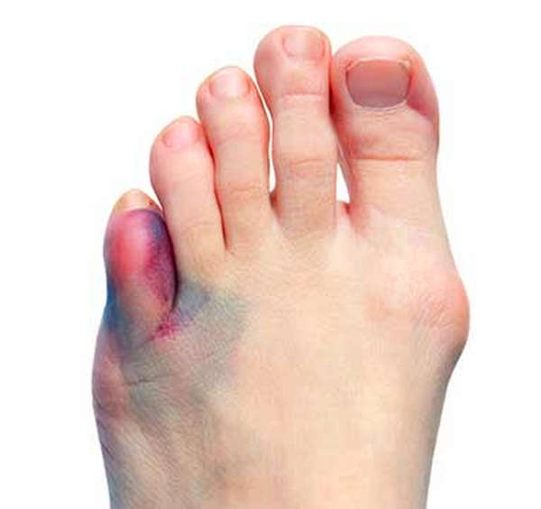 A toe fracture takes time to heal Sprained image photo picture