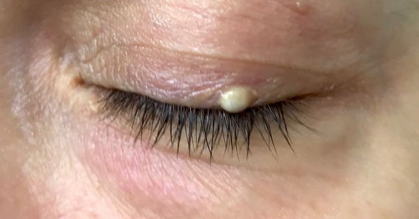 A whitish to yellowish bump or pimple on the eyelid image photo picture