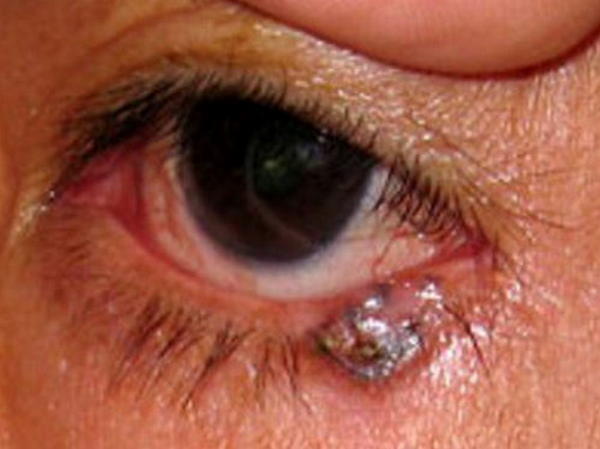 An ingrown eyelash in the lower eyelid image photo picture