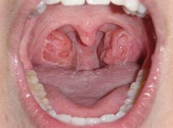 Both tonsils are inflamed and have numerous craters Holes in tonsils image photo picture