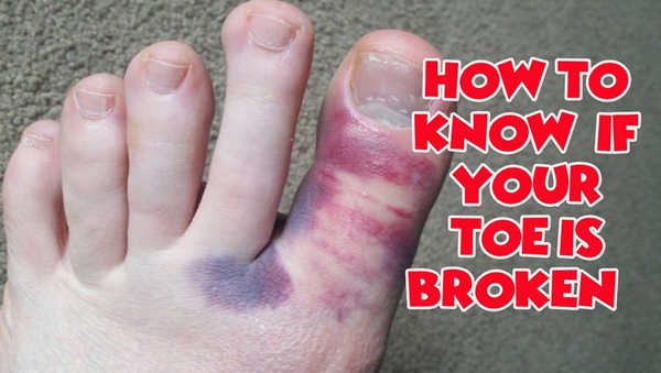 Distinguishing a sprained toe from a broken toe image photo picture