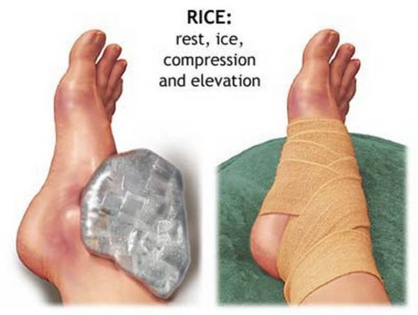 The RICE method is the standard management approach for injury Sprained Toe image photo picture