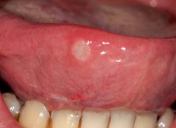 Herpes On Tongue Why Is My Tongue White Causes Symptoms 