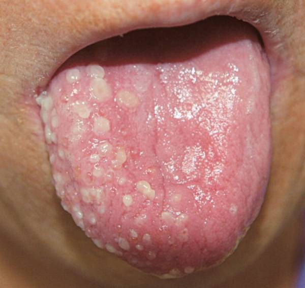 Herpes On Tongue Symptoms How To Get Rid Of Treatment Pictures The