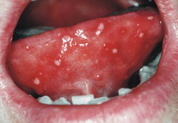 Herpes on Tongue - Symptoms, How to get rid of (Treatment) & Pictures