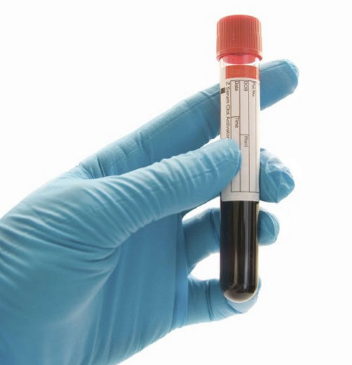 A blood sample is taken and check for the presence of alcohol-blood alcohol concentration image photo picture