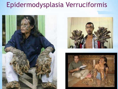 A classic manifestation of a person with epidermodysplasia verruciformis image photo picture