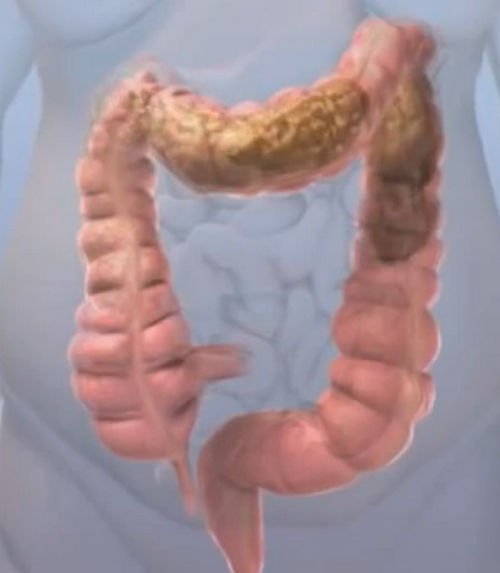 A closer look at an intestine with obstructed fecal matter image photo picture