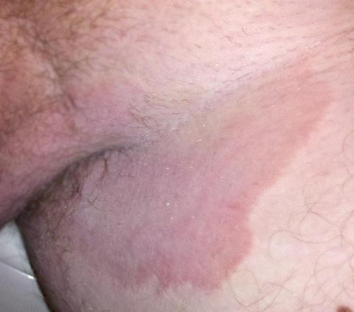 A dermatophyte infection in the groin area image photo picture