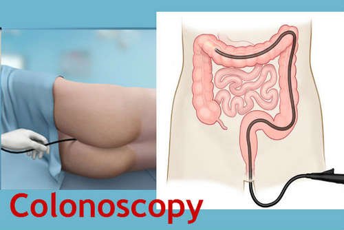 A patient undergoing a colonoscopy procedure image photo picture