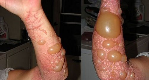 A severe poison sumac rash that warrants immediate medical attention photo picture image