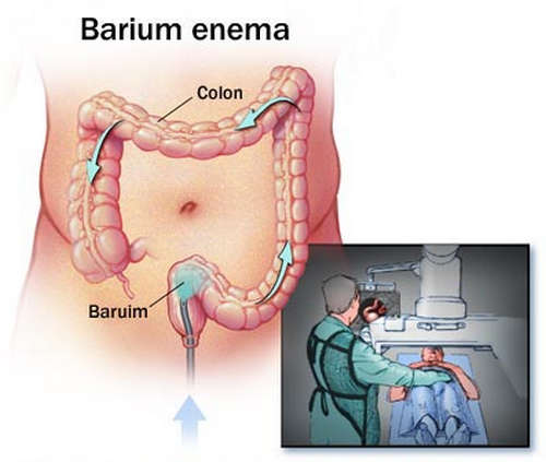 Barium enema is one of the diagnostic procedures used to detect the causes of obstipation image photo picture