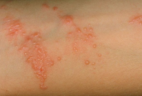 Poison sumac rashes characterized by reddening of the skin and the presence of blisters image picture photo