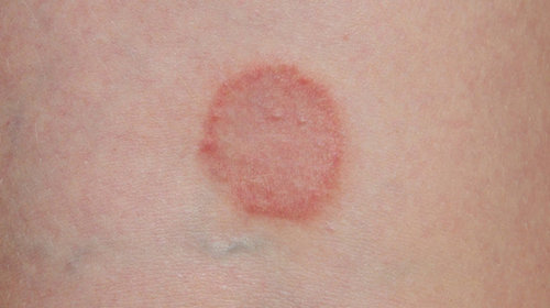 The typical characteristic of a ringworm image photo picture