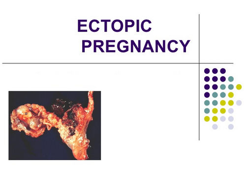 An ectopic pregnancy is one of the possible causes of decidual cast image photo picture